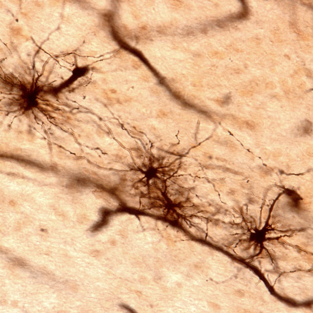 stem cell treatment for als stem cell treatment for als