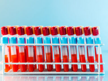 Early diagnosis of ALS using blood levels of copper isotopes