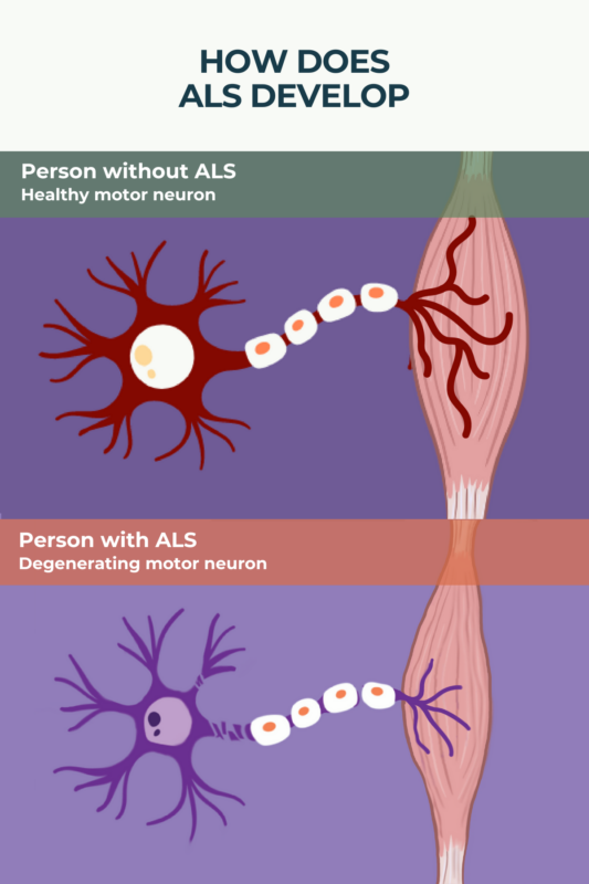 Infographic showing how the causes of ALS