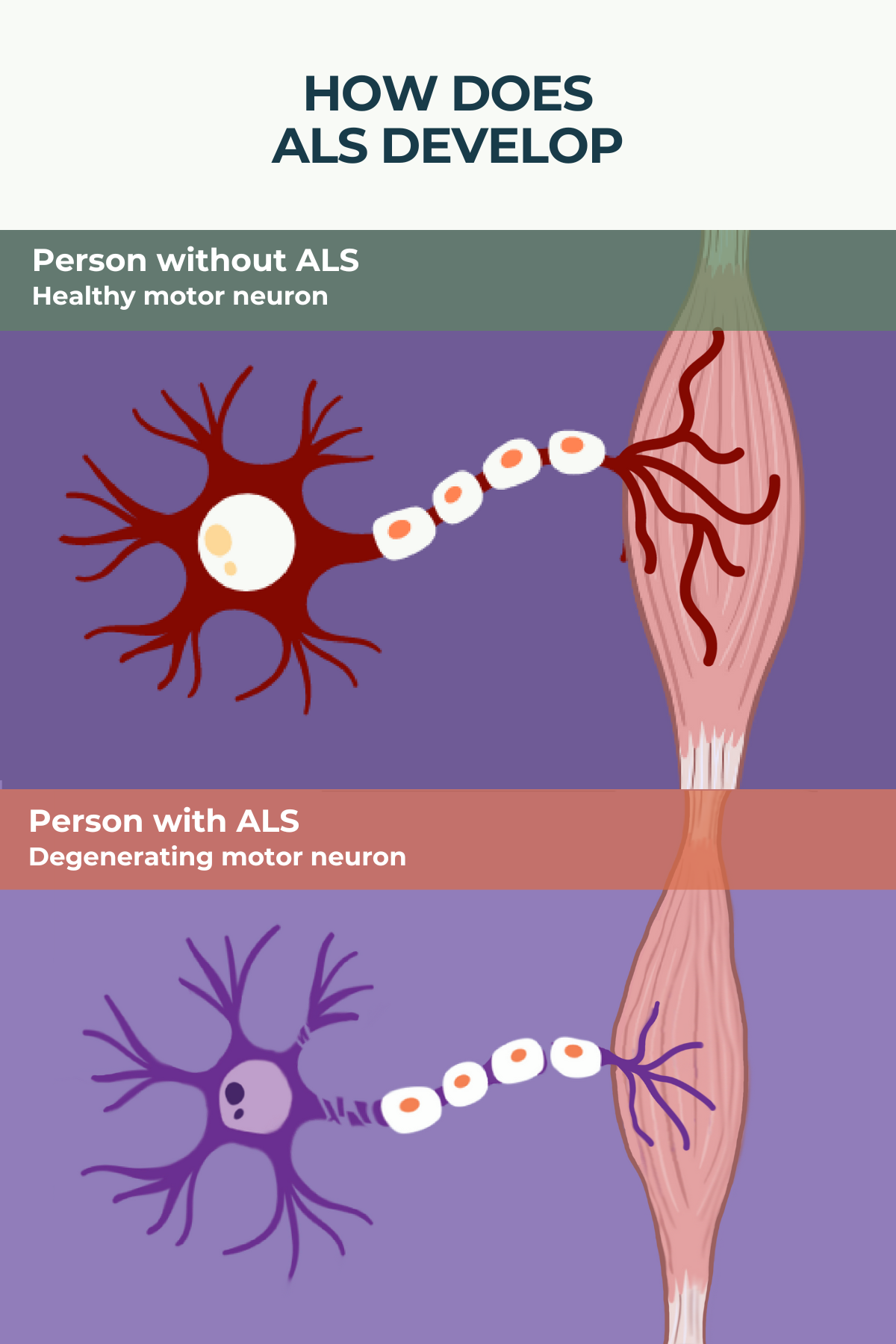 What is Amyotrophic Lateral Sclerosis (ALS)? ALS News Today