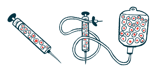 Two syringes and an intravenous medication bag, all for use in delivering a stem cell therapy to a patient, are pictured.